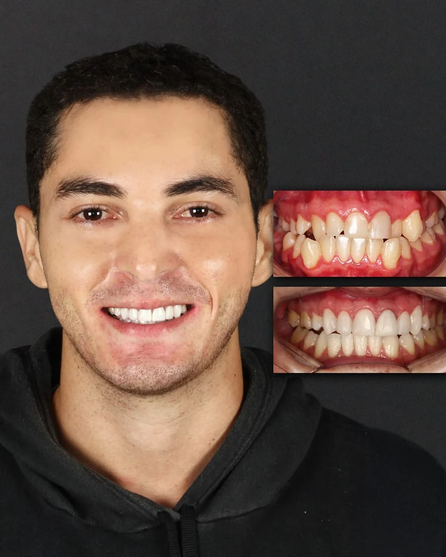 Cesar, paciente PRÓ-ODONTO — antes e depois do tratamento