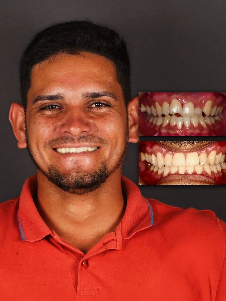 Eduardo, paciente PRÓ-ODONTO — antes e depois do tratamento