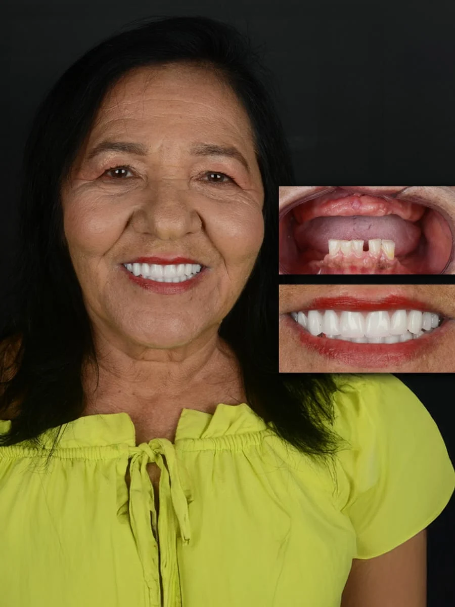 Josefa Marlene, paciente PRÓ-ODONTO — antes e depois do tratamento