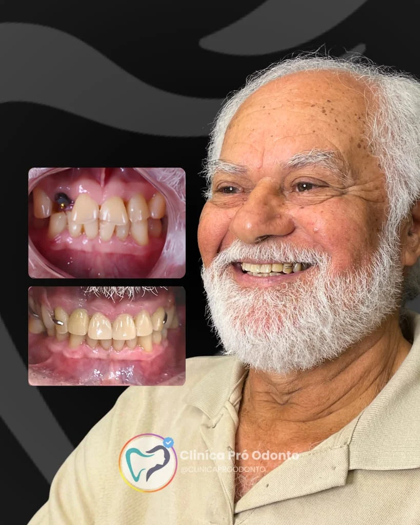 Manoel, paciente PRÓ-ODONTO — antes e depois do tratamento