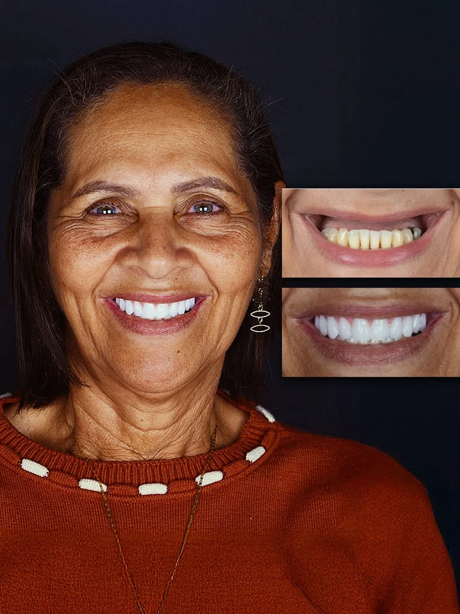 Dona Valdinete, paciente PRÓ-ODONTO — antes e depois do tratamento